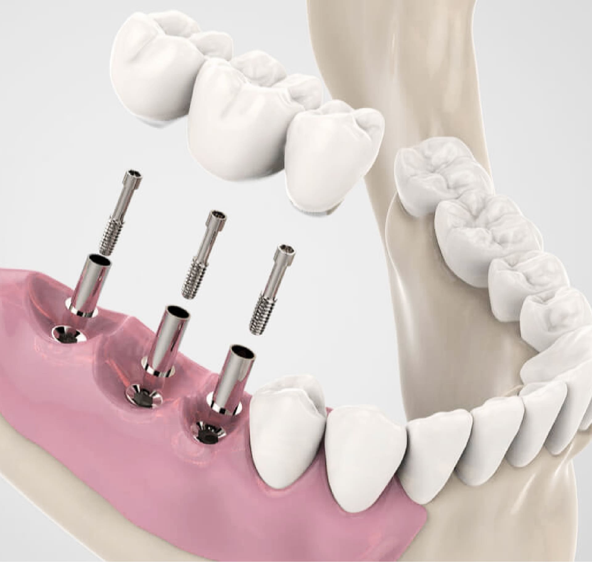 estetica-dentale-studio-odontoiatrico-ferri