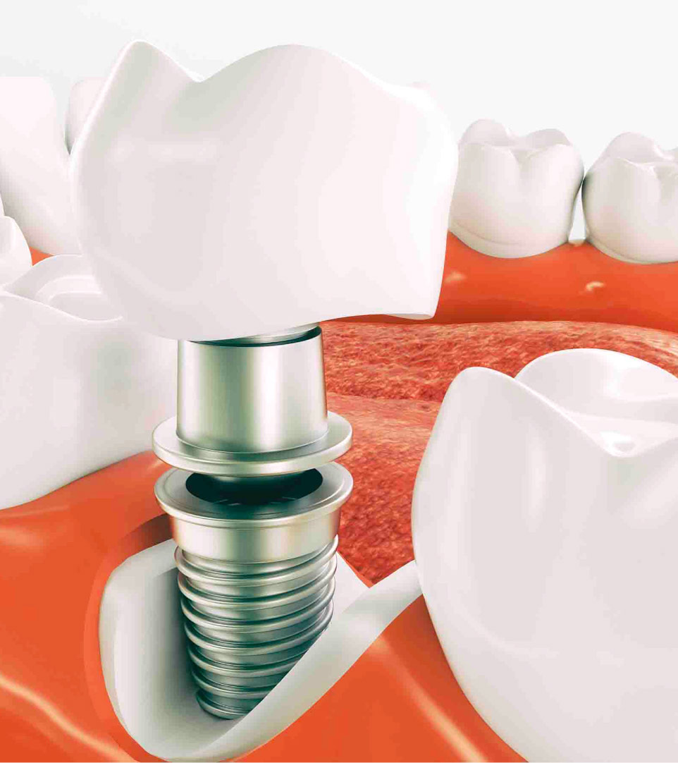 Implantologia-dentale-studio-odontoiatrico-ferri