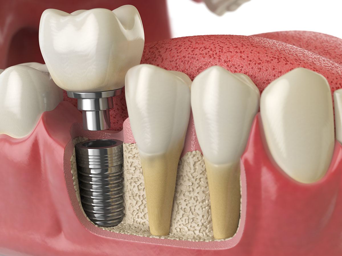 implantologia-dentale-Studio-odontoiatrico-ferri